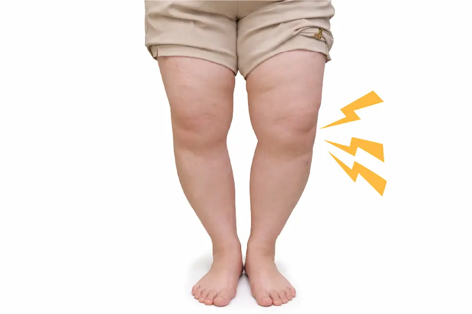 変形性膝関節症（O脚変形）