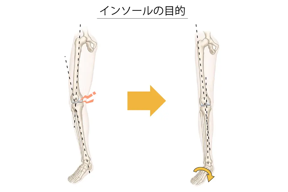 変形性膝関節症（インソールの目的）