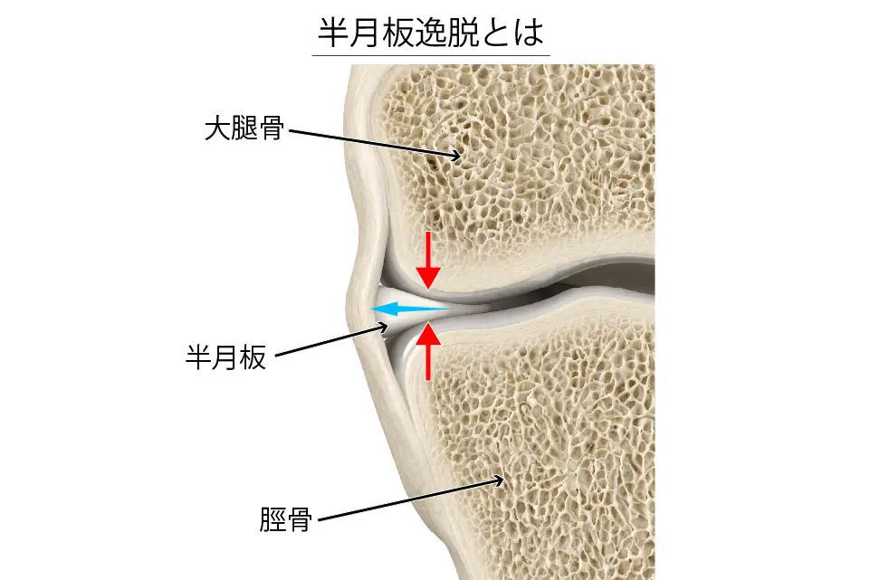 変形性膝関節症（半月板逸脱）