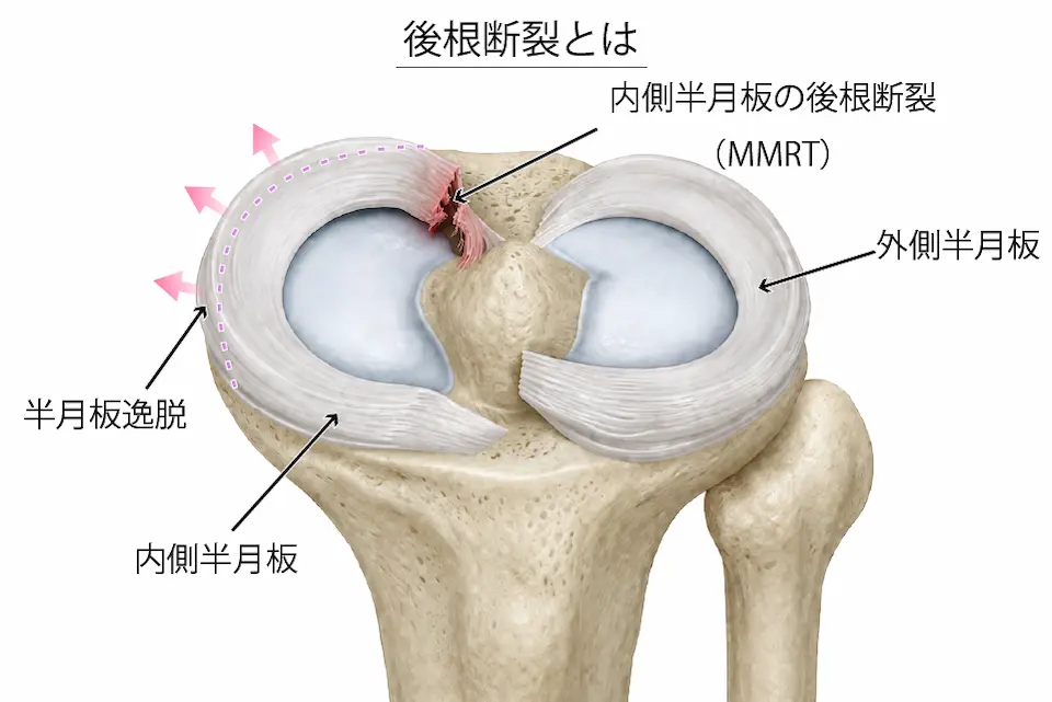 変形性膝関節症（後根断裂）