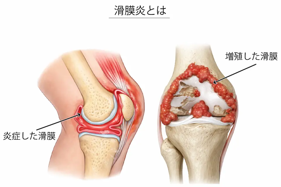 変形性膝関節症（滑膜炎）