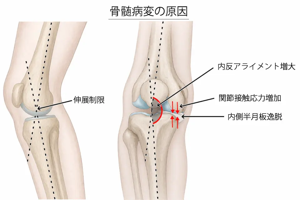 変形性膝関節症（骨髄病変の原因）
