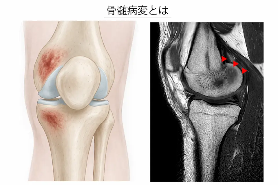 変形性膝関節症（骨髄病変）