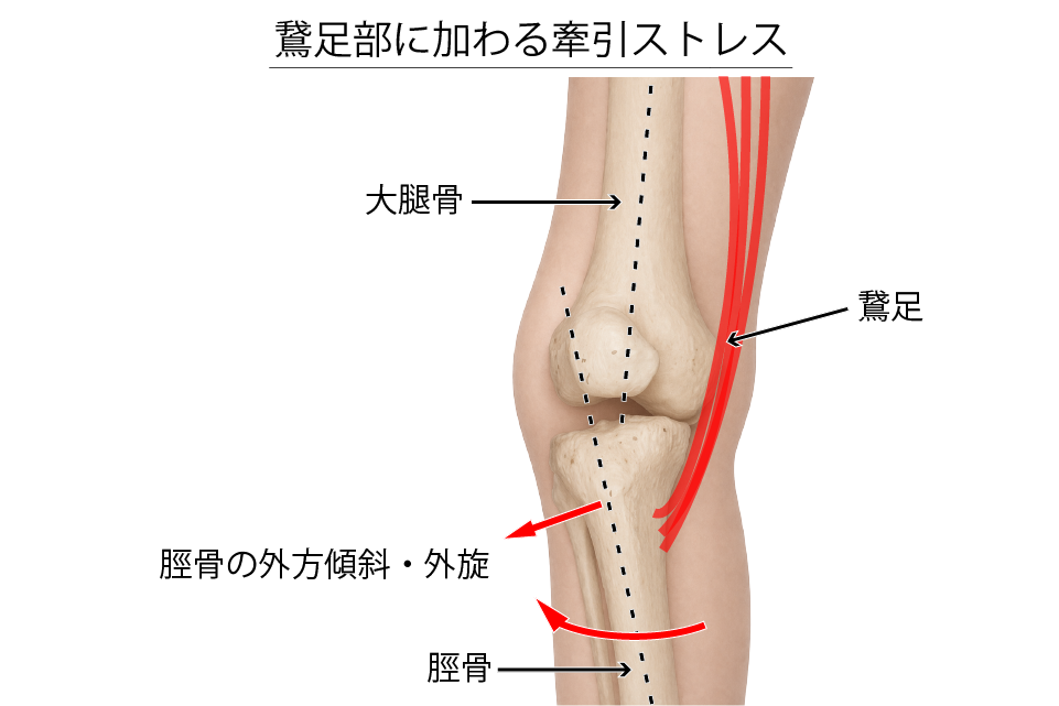変形性膝関節症（鵞足部に加わる牽引ストレス）
