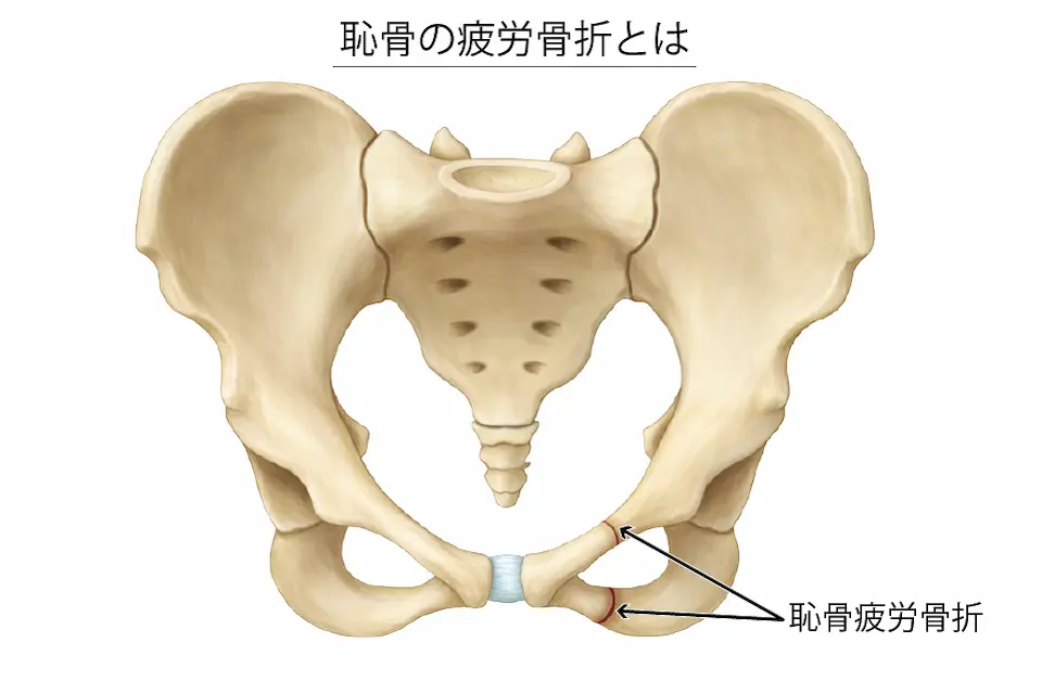 恥骨の疲労骨折とは