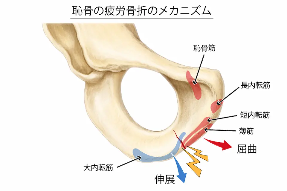 恥骨の疲労骨折のメカニズム