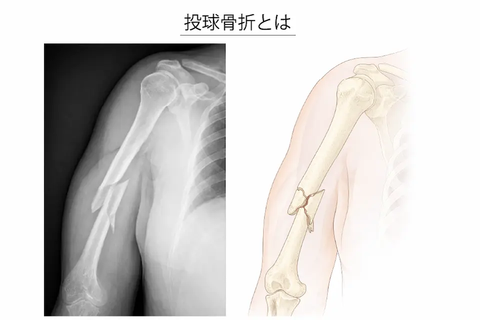 投球骨折とは