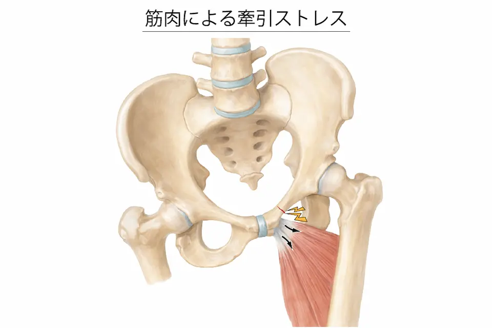 筋肉による牽引ストレス