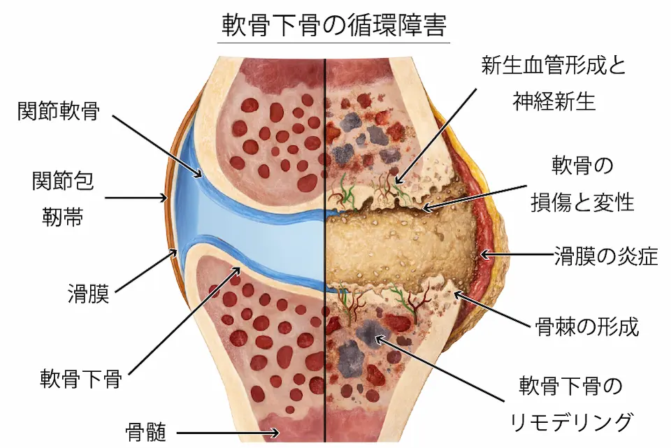 軟骨下骨の循環障害