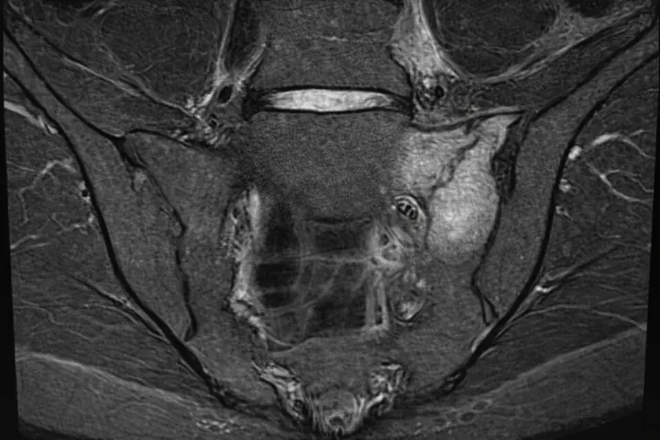 骨盤MRIスキャンの詳細