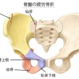 骨盤の疲労骨折｜超音波治療による早期回復サポート