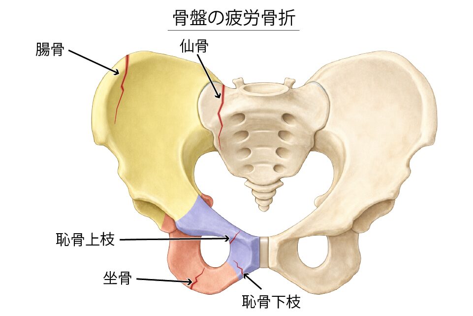 骨盤の疲労骨折