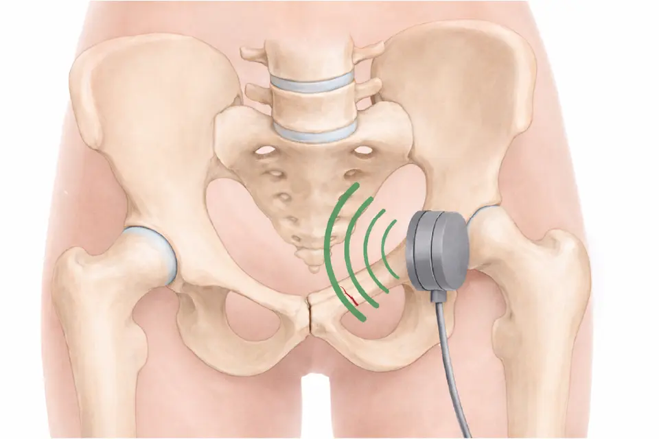 骨盤の疲労骨折に対するLIPUS