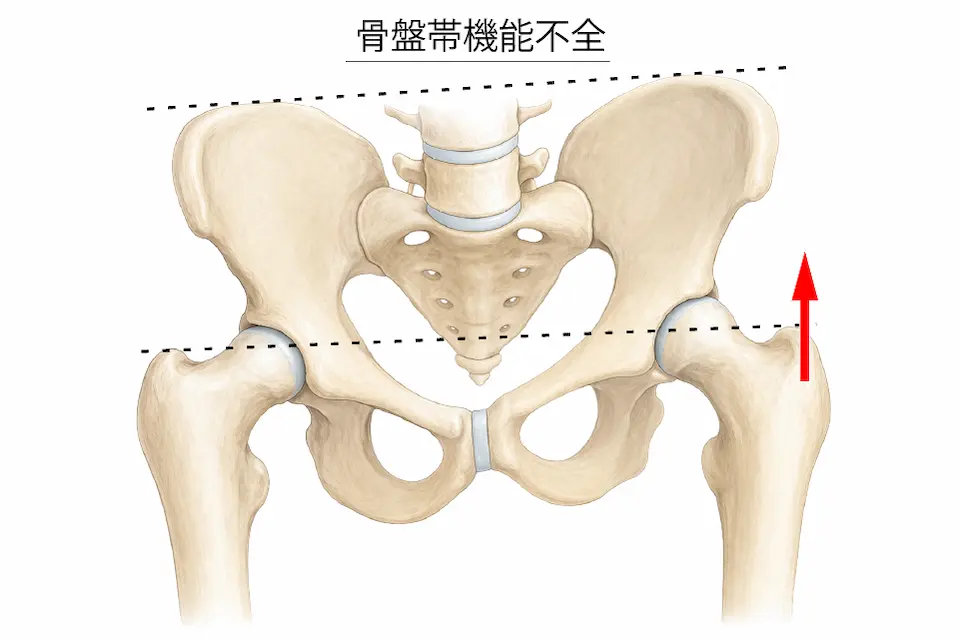 骨盤帯機能不全