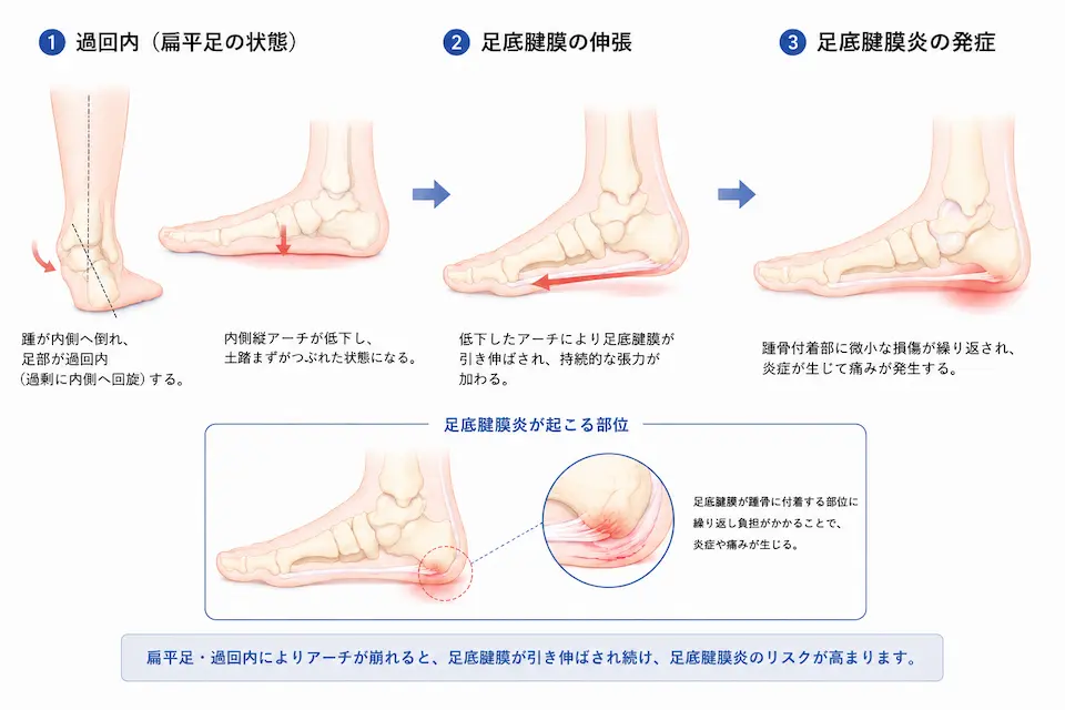 過回内・扁平足タイプの足底腱膜炎