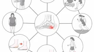 足底腱膜炎が治らないのはなぜ？原因・症状・治療法を専門的にわかりやすく解説