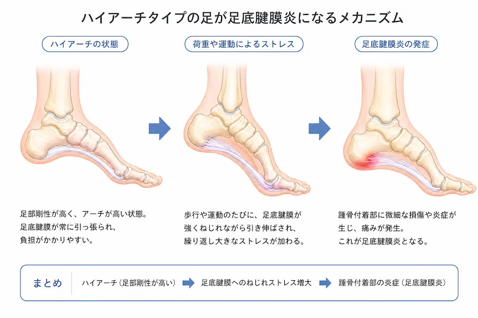 ハイアーチが足底腱膜炎になる理由