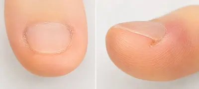 深爪