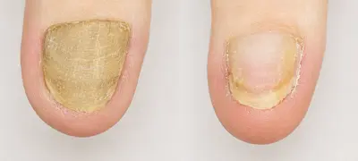 肥厚爪