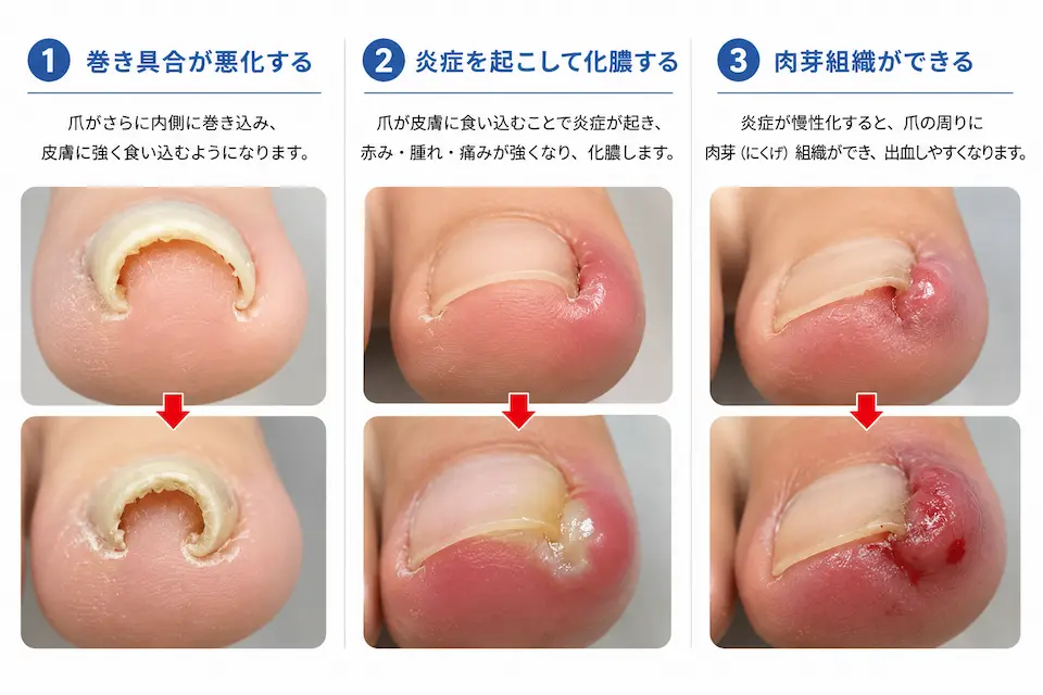 巻き爪が悪化したらどうなる？