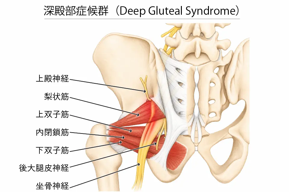 Deep Gluteal Syndrome
