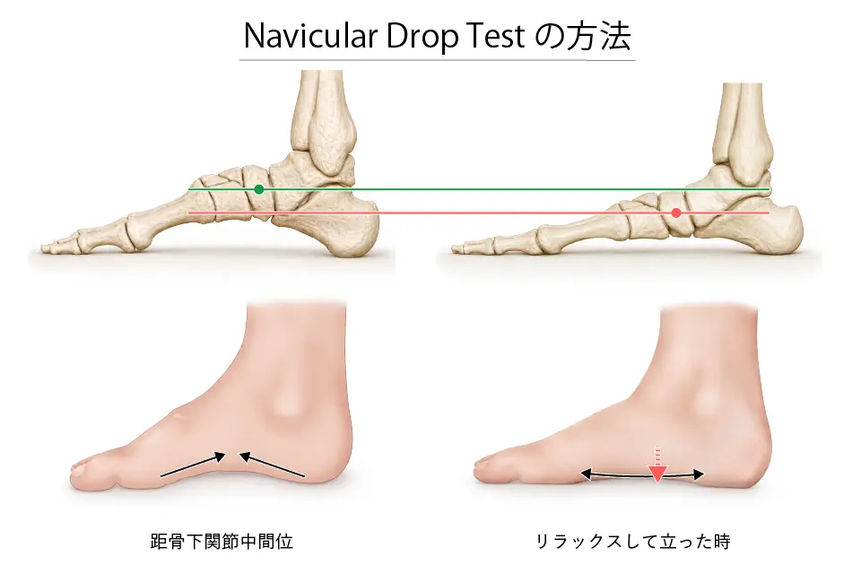 Navicular Drop Testの方法