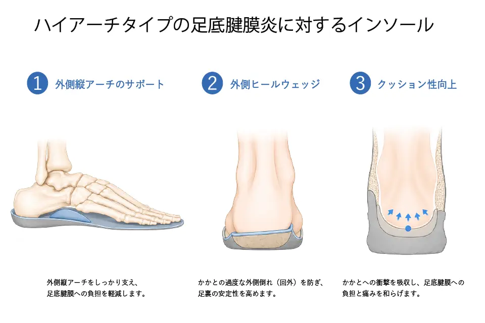 ハイアーチタイプの足底腱膜炎に対するインソール