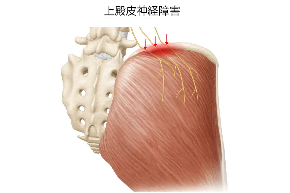 上殿皮神経障害
