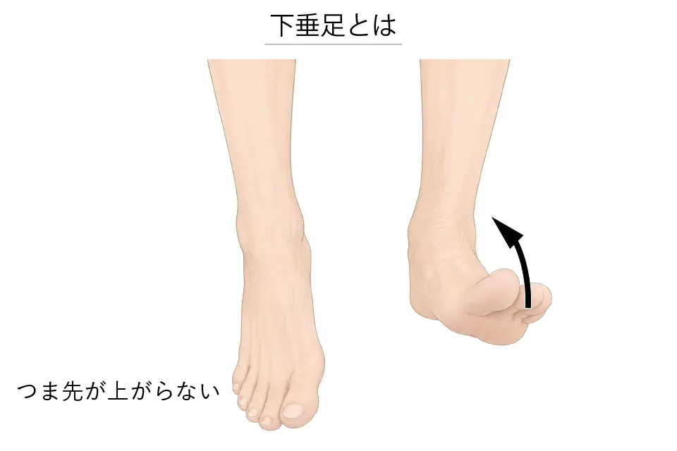 下垂足とは