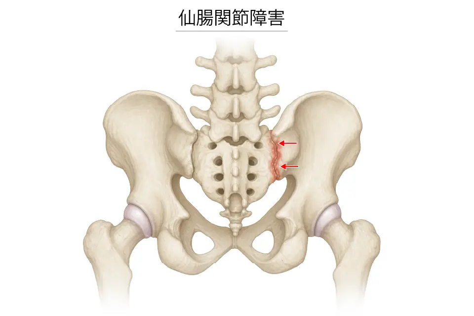 仙腸関節障害