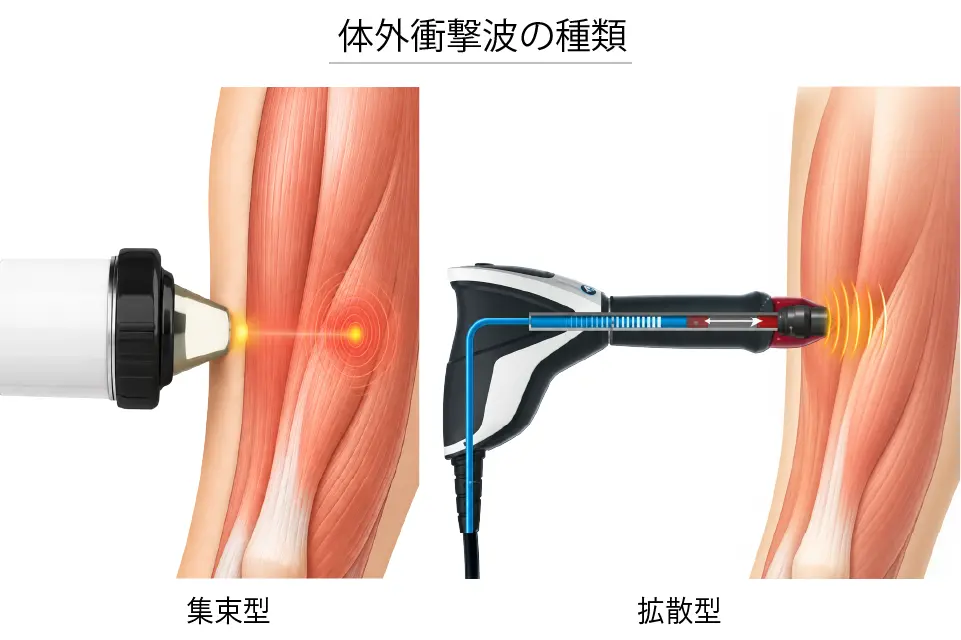 体外衝撃波の種類