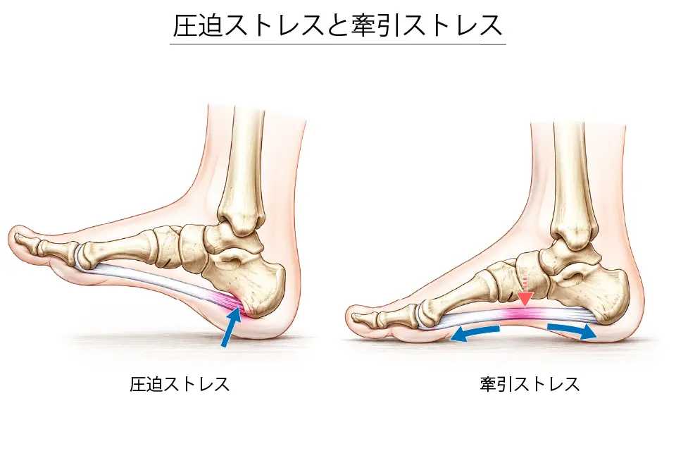 圧迫ストレスと牽引ストレス