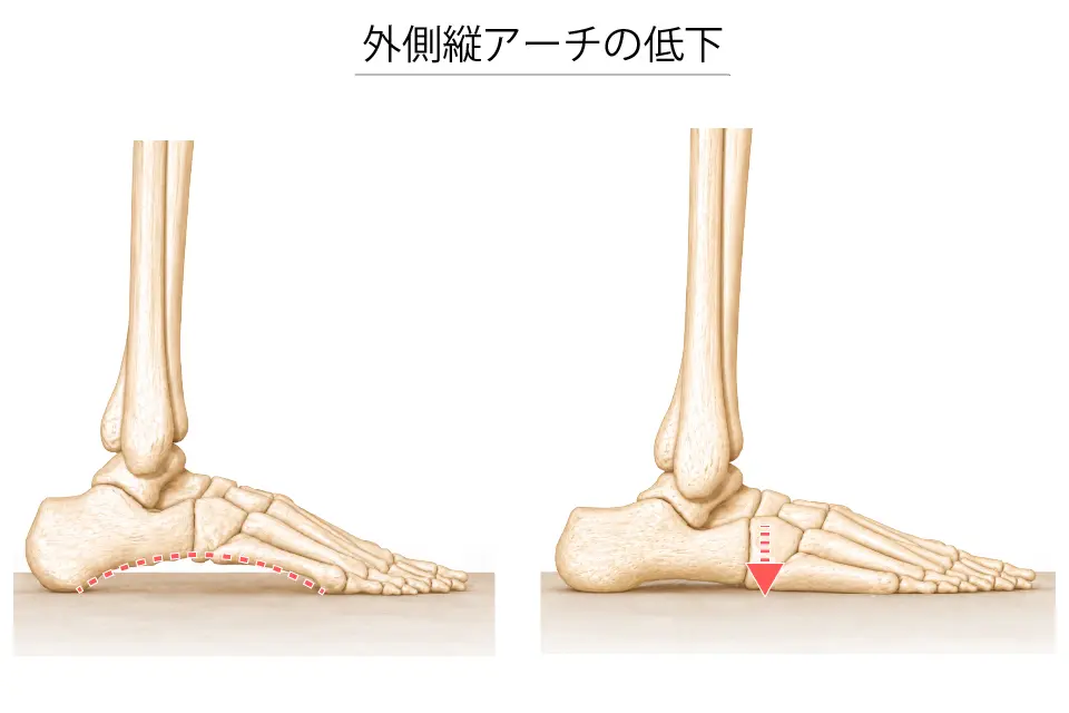外側縦アーチの低下