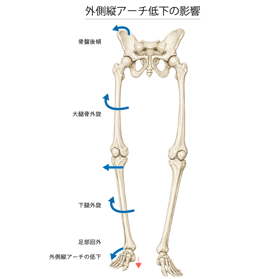 外側縦アーチ低下の影響