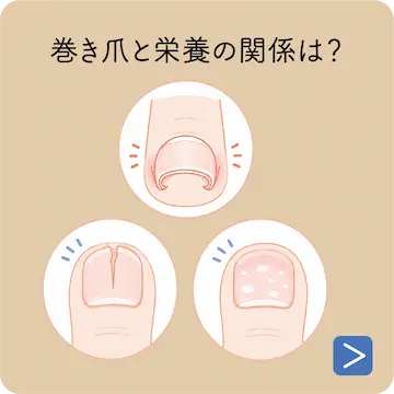 巻き爪と栄養の関係は？