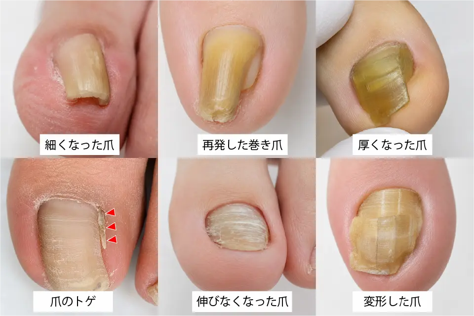 巻き爪手術後の再発例