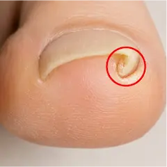 巻き爪片足１箇所