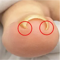 巻き爪片足２箇所