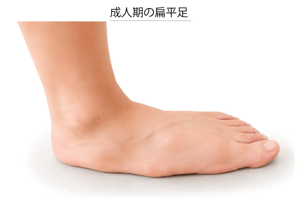 成人期の扁平足