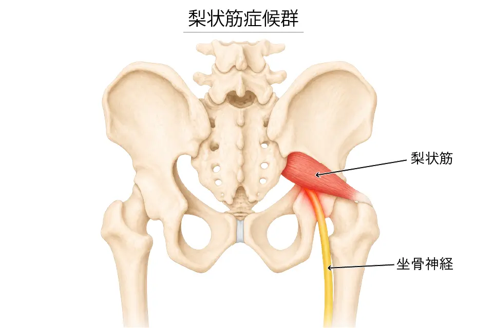 梨状筋症候群