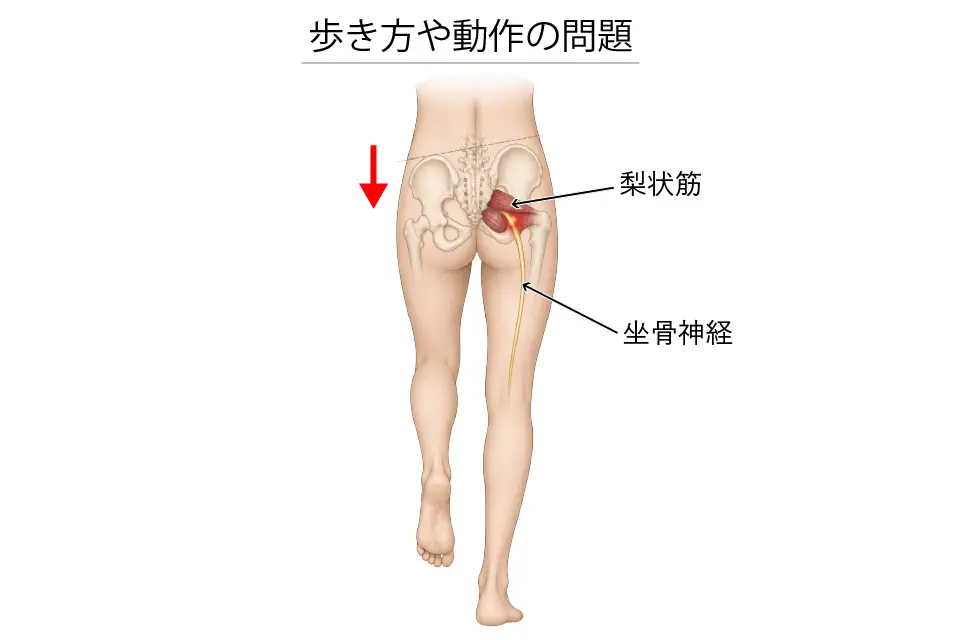 歩き方や動作の問題