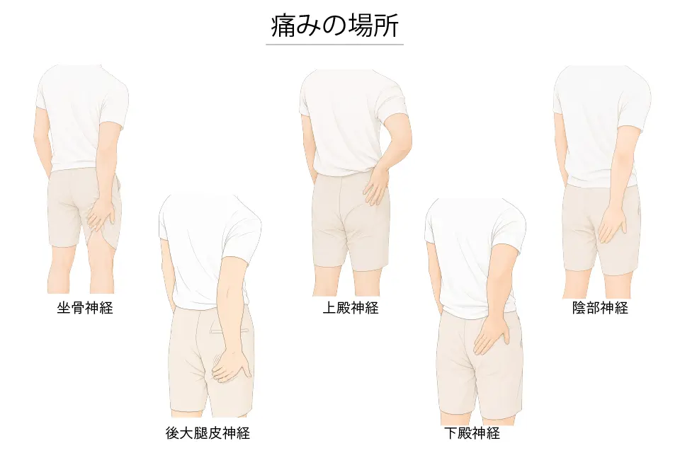 深殿部症候群（痛みの部位）