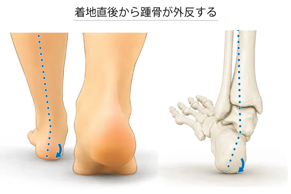 着地直後から踵骨が外反する