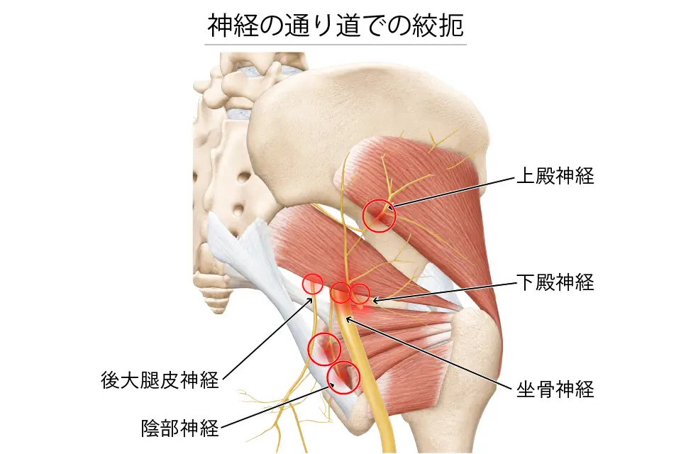 神経の通り道での絞扼