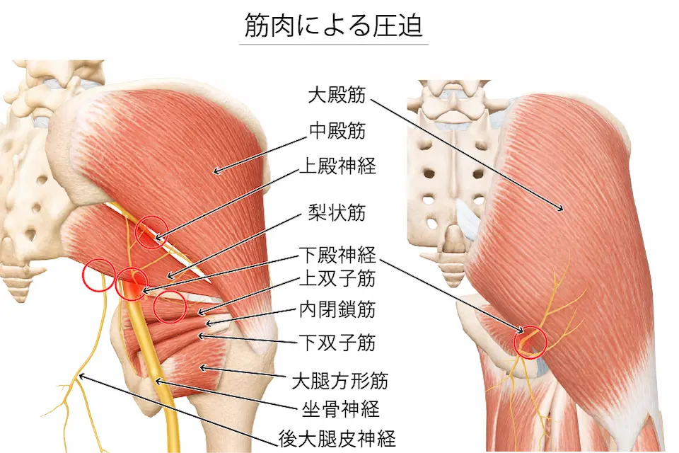 筋肉による圧迫