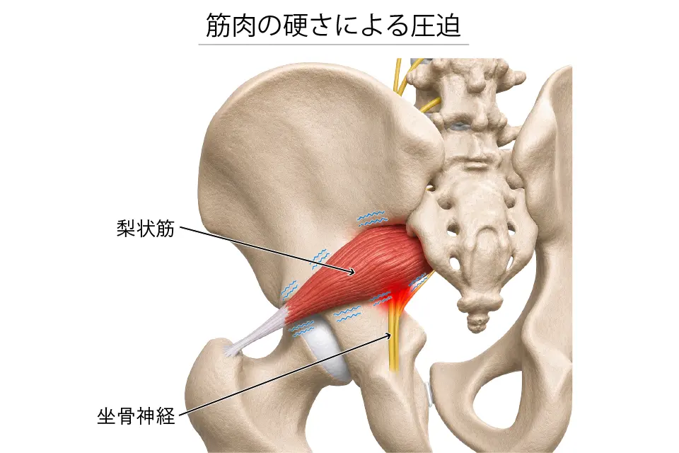筋肉の硬さによる圧迫