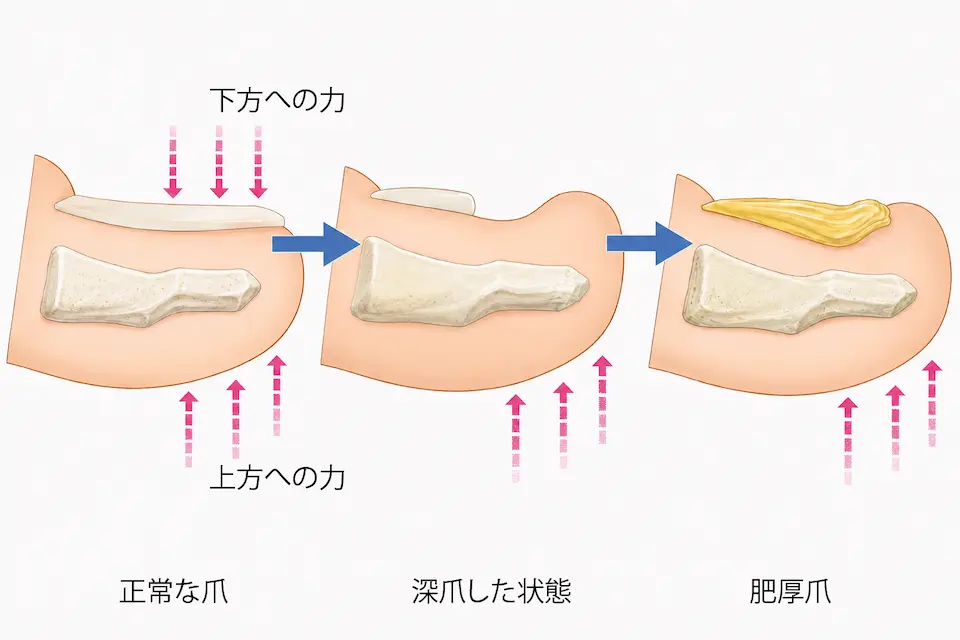 肥厚爪へのメカニズム