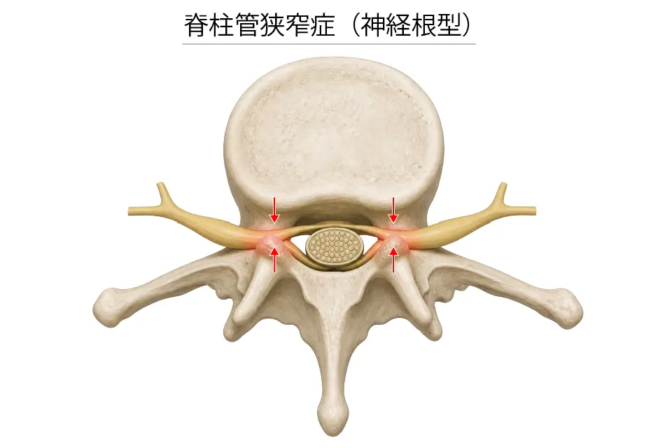 脊柱管狭窄症（神経根型）