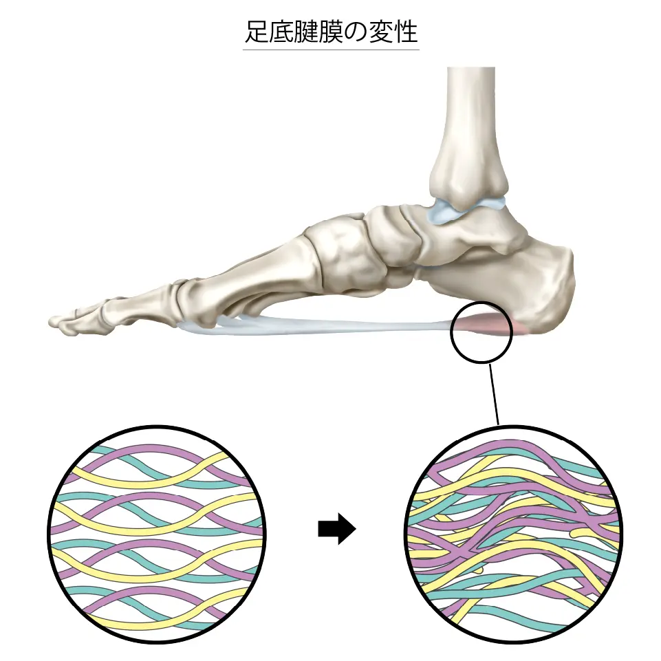足底腱膜の変性