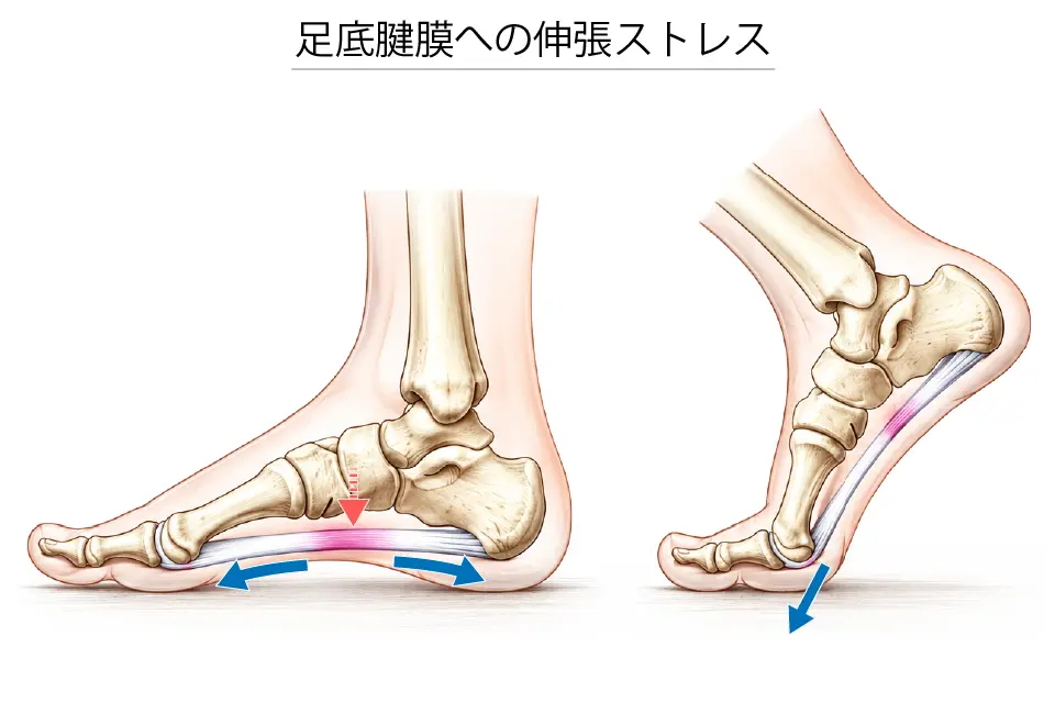 足底腱膜への伸張ストレス